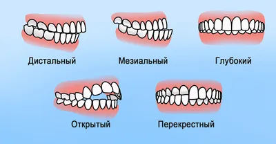 Неправильный прикус | Стоматология «АльтоДент» в Орехово-Зуево