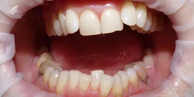 Коронки на зубах занизили прикус и разрушили другие зубы – клиника Smile  STD, Москва