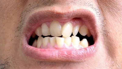 Реконструкция прикуса и зубов