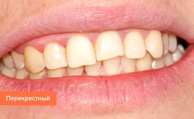 Кривые зубы у подростков в 16 лет. Как и чем исправлять прикус | Клиника  Ортодонтика, Москва