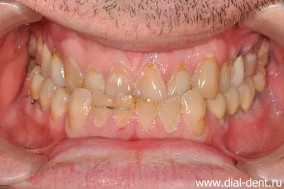 Неровные зубы: как исправить, и что делать при неправильном прикусе