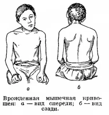 Кривошея - Первая Медицинская Клиника