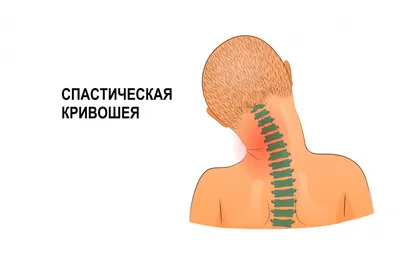 Кривошея у детей: как определить и чем лечить❓ | Твой доктор | Дзен