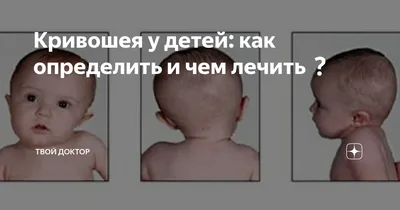 Кривошея и косоглазие у детей - энциклопедия Ochkov.net