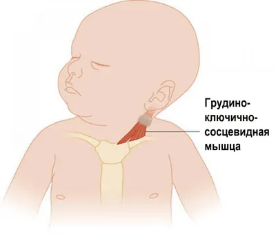 Кривошея - частая проблема у грудничков👶 | Instagram