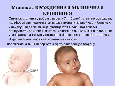 Кривошея у детей: причины, проявления, лечение в СПб