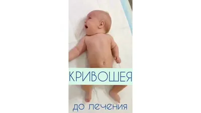 Кривошия та «залежана голівка» у немовлят | Zarpa