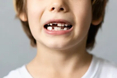 Кривые зубы у детей: причины роста неровных молочных зубов и методы  исправления кривизны