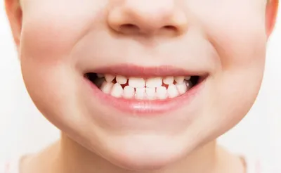 Причины, по которым у детей растут кривые зубы – Ortholike