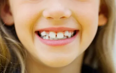 Кривые передние зубы | Причины и способы лечения