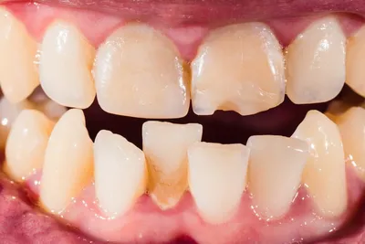 Кривые зубы у детей фото фото