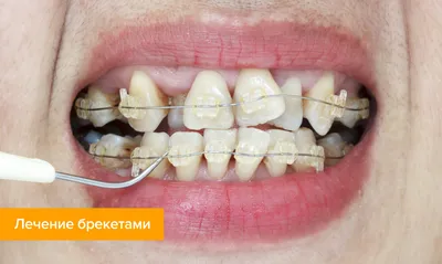 Кривые зубы — как их исправить? Что делать с кривыми зубами — ответ на  Startsmile.ru