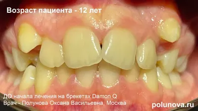 Что делать, если у ребенка в 13 лет кривые или неровные зубы | Клиника  Ортодонтика, Москва