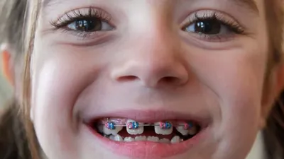 Кривые зубы у детей - причины роста и способы исправления кривых зубов у  ребенка