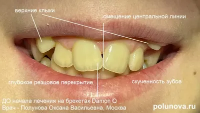 Что делать, если у ребенка в 13 лет кривые или неровные зубы | Клиника  Ортодонтика, Москва