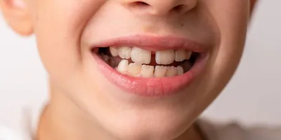 Кривые зубы у детей и взрослых - причины, как исправить, что делать, если  зуб растет криво