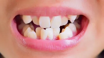 У ребенка растут кривые зубы — что делать? | Блог на стомпратика.рф