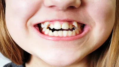 Почему растут кривые зубы у ребенка - распространенные причины