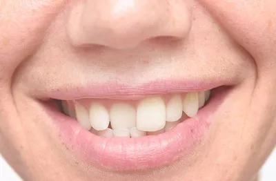 Кривые зубы у ребёнка 6 лет. Что делать? | Консультация врача | Брекет.Info