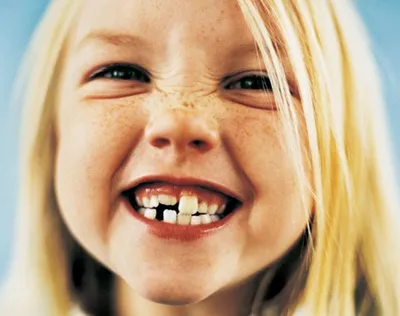 Кривые зубы у детей: причины роста неровных молочных и постоянных зубов,  как исправить дефект челюсти