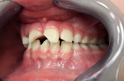 У детей растут кривые зубы – что делать, почему неровно лезут коренные  постоянные и молочные элементы: как исправить, если режутся, выходят,  вылазят очень плохо (фото)