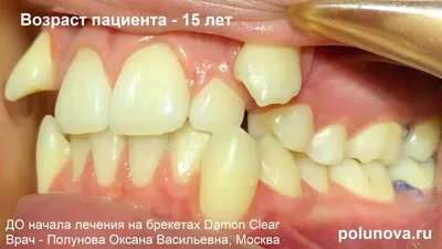Кривые зубы у детей: фото, лечение. Что делать, если зуб растет криво