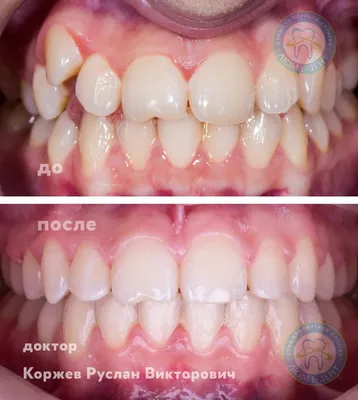 Кривые зубы – что делать, как исправить кривизну зубного ряда