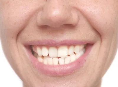 Кривые Зубы 9 Фото Что Делать Как Исправить ЛюмиДент