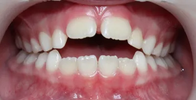 Почему зубы растут неровно и что делать - Статья стоматологии Доктор Келлер  в Ростове-на-Дону
