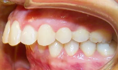 Кривые зубы: Проблема со здоровьем