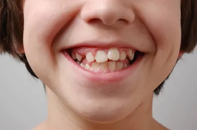 Кривые зубы у детей и взрослых: причины, способы лечения, влияние на челюсть