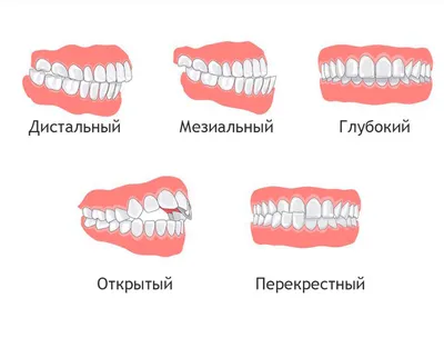 Неправильный прикус у ребенка — виды, причины, лечение в статье журнала  Startsmile