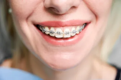 привлекательная маленькая девочка с улыбкой дети кривые зубы детская  стоматология Стоковое Изображение - изображение насчитывающей доктор,  микстура: 221582753