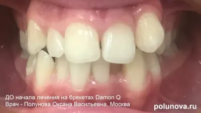 Кривые зубы у детей в 14 лет. Как и чем исправлять прикус | Клиника  Ортодонтика, Москва