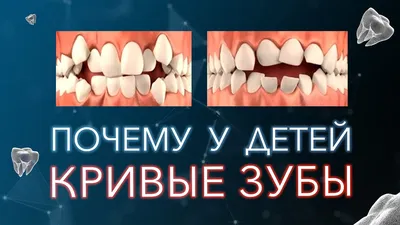 Коронки на кривые зубы: особенности установки