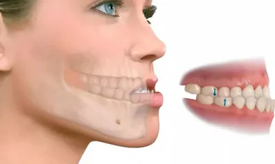 Раннее ортодонтическое лечение ребенка с расширением верхней челюсти