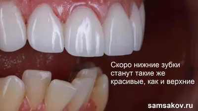 Кривые зубы у детей | Лечение и последствия - YouTube