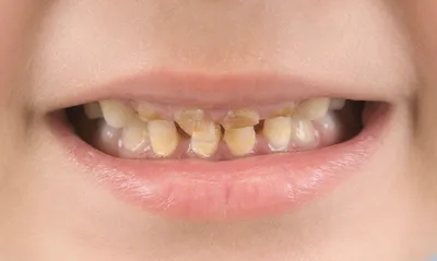 Кривые зубы у детей. Почему так происходит и что с этим делать. - YouTube