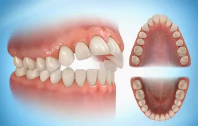 Что делать, если зубы кривые?