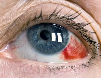 Кровоизлияние в глаз» (субконъюнктивальное кровоизлияние). Куда бежать? Что  делать? | Центр Ока