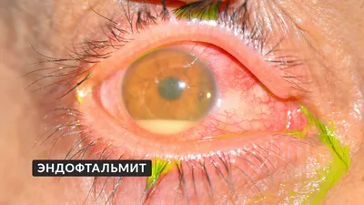 Медичний офтальмологічний центр «Технологія здоров'я» - Покраснение глаз  принимают за лопнувшие сосуды. А это не совсем так. Такие покраснения  связаны с общим или локальным расширением сосудов конъюнктивы глаза. Когда  сосуд разрывается, то