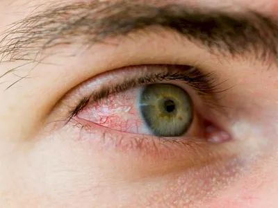 Кровоизлияние в глаз или гемофтальм - что это такое