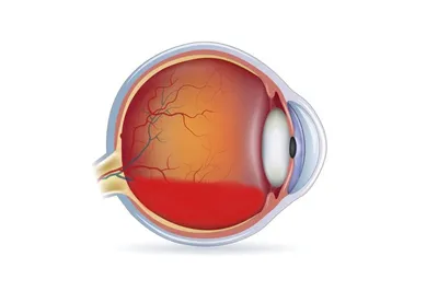 Кровоизлияние в глаз - причины, лечение