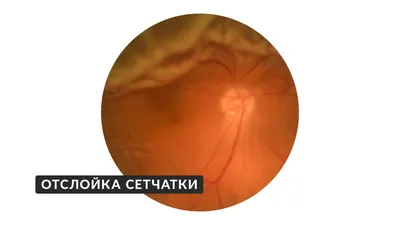 Травмы глаза – лечение и симптомы при кровоизлияниях, ранениях роговицы и  других повреждениях