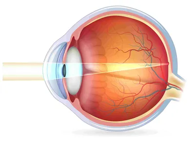 Кровоизлияние в глаз – причины и лечение красного пятна в глазу