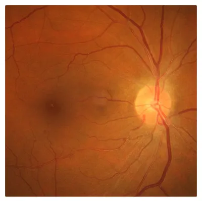 Гемофтальм – основные причины и симптомы заболевания | Хирургия глаза