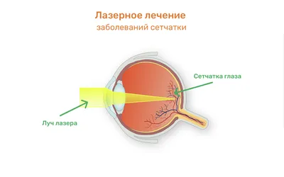 Отслоение сетчатки глаза - симптомы, причины, лечение с помощью операции и  профилактика