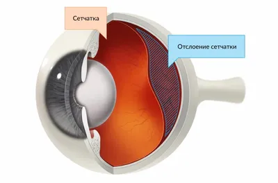 Диабетическая ретинопатия: проблемы со зрением, связанные с сахарным  диабетом