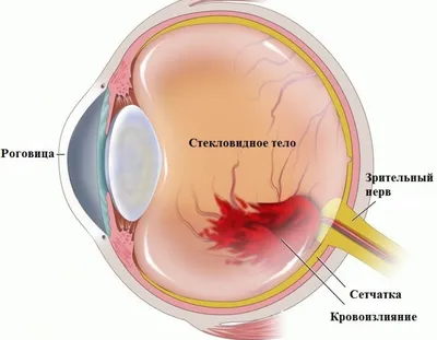 Кровоизлияние в глаз - причины, лечение