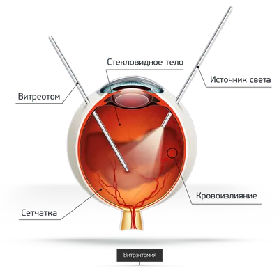 Клиника Здоровье - Сетчатка глаза: заболевания и их лечение